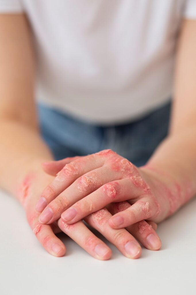 artrite psoriática na mão