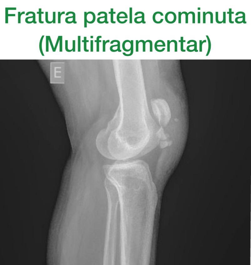 fratura da rótula com desvio 