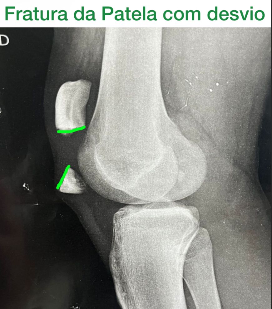 fratura de patela com desvio, radiografia