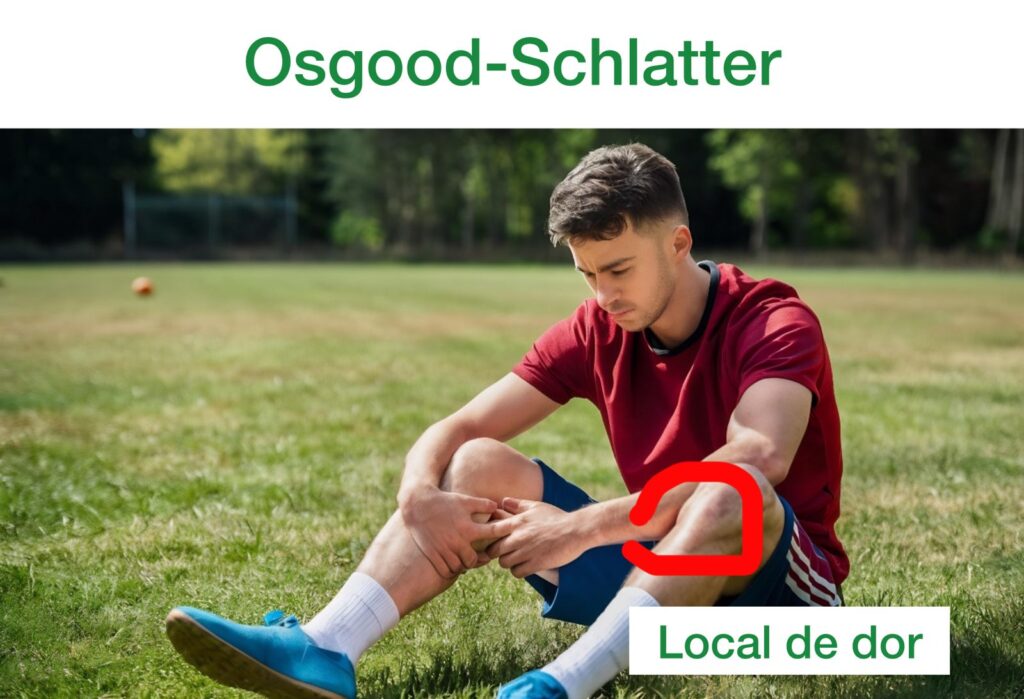 adolescente com Osgood-schlatter no joelho, em vermelho a região de dor