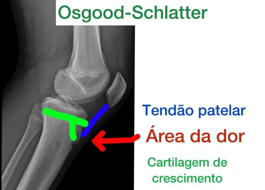 radiografia mostrando Osgood-Schlatter